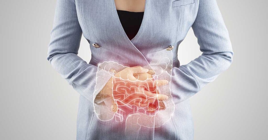 O que é diverticulite intestinal? Entenda os sintomas e o tratamento