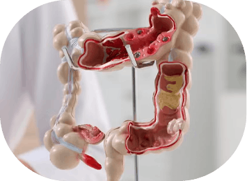 Câncer de Intestino