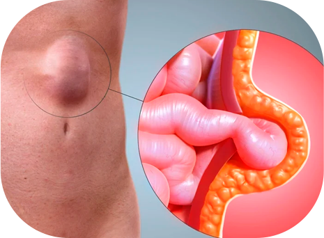 Cirurgia de hérnia epigástrica em Uberlândia